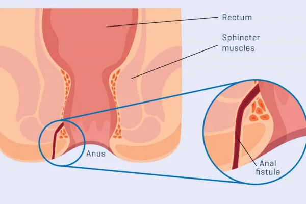 Top Fistula Surgeon Mumbai Share Their Secrets: From Diagnosis To Healing